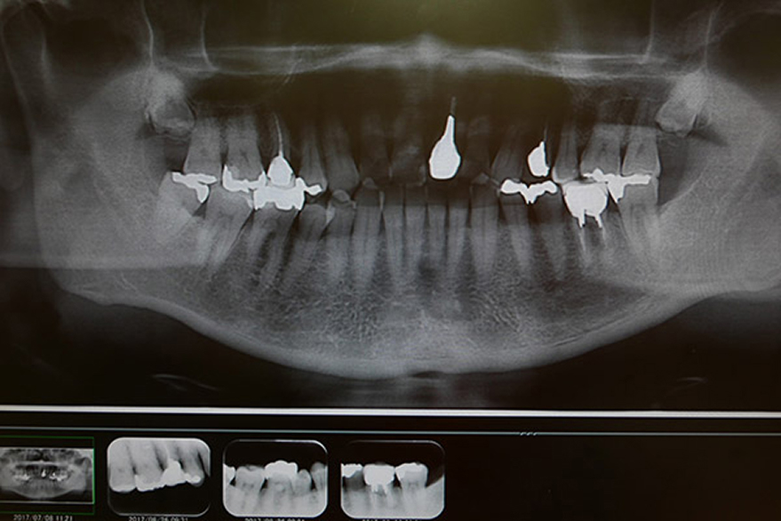 デジタルレントゲン