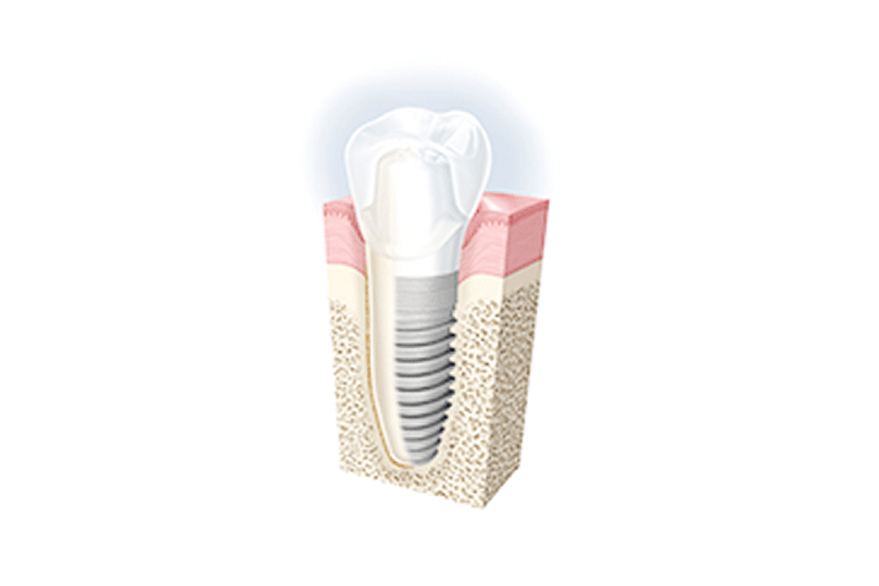 インプラント治療