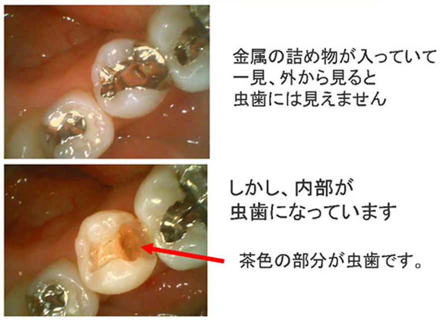 従来の保険むし歯治療法