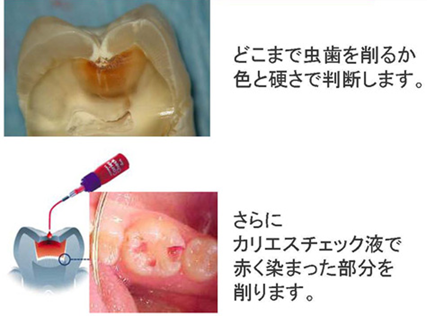 従来の保険むし歯治療法