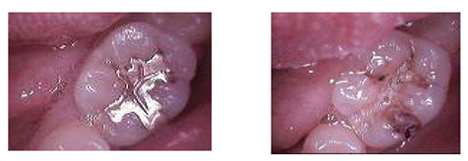 従来の保険むし歯治療法