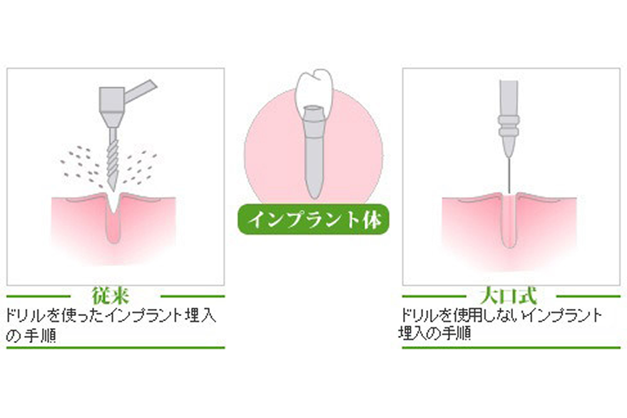 インプラント治療