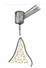 OAMインプラント