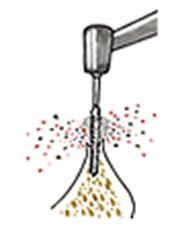 従来のインプラント