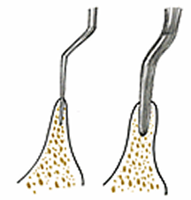 OAMインプラント