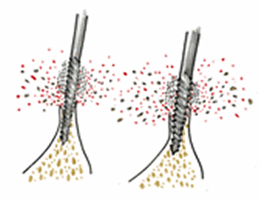 従来のインプラント