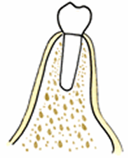 OAMインプラント