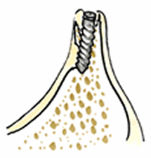 従来のインプラント