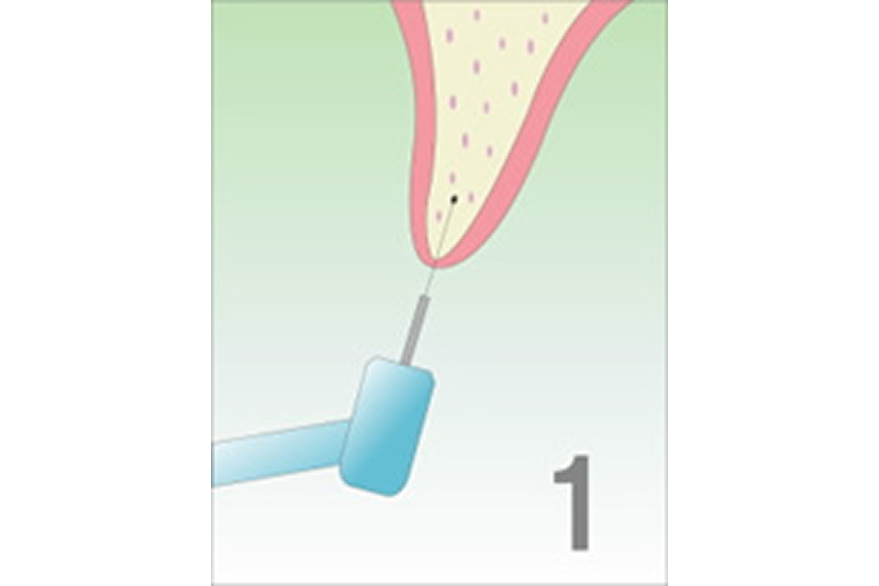 OAMインプラント療法の手順