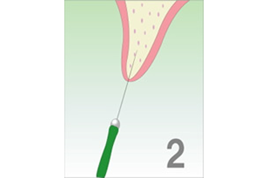 OAMインプラント療法の手順
