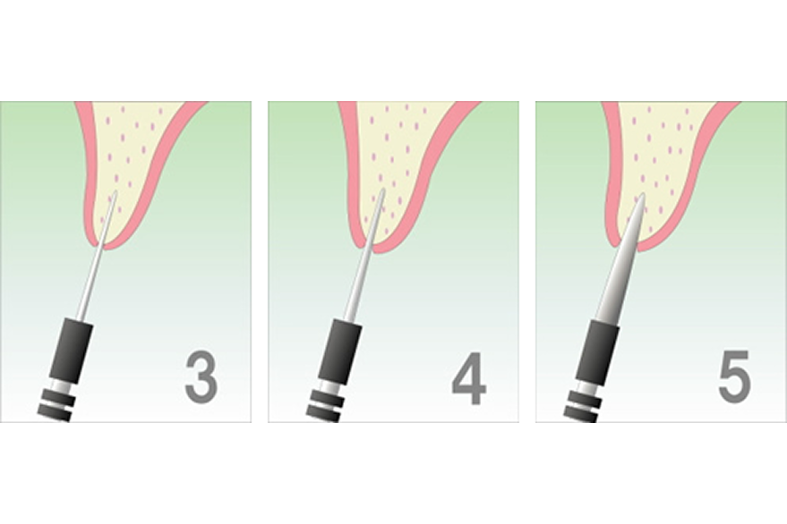 OAMインプラント療法の手順