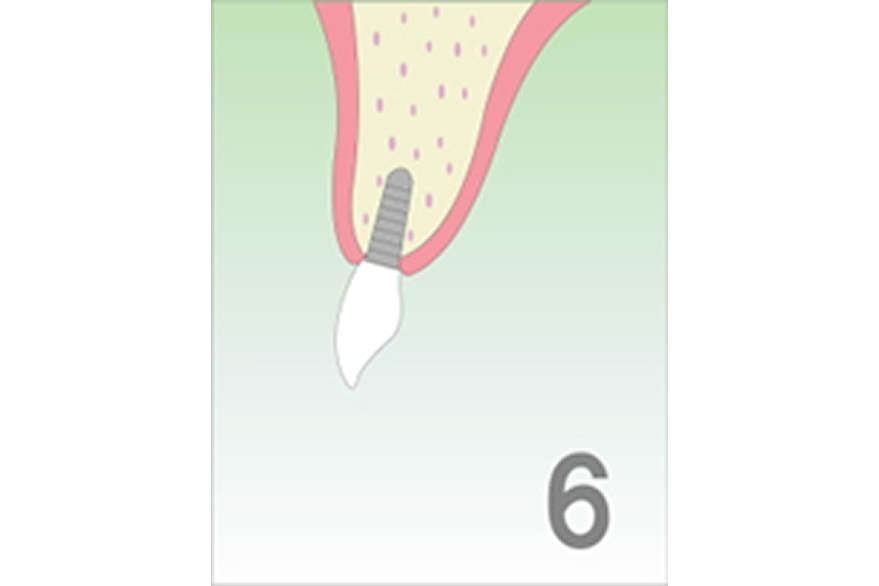 OAMインプラント療法の手順
