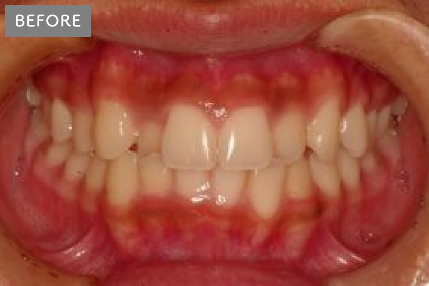 上の前歯にガタツキがあります。