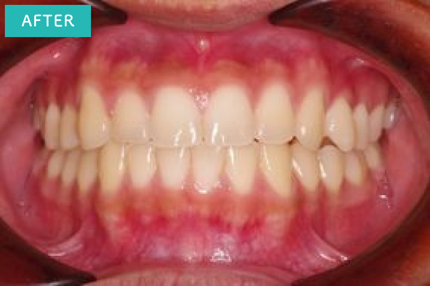 前歯がきれいになりました。