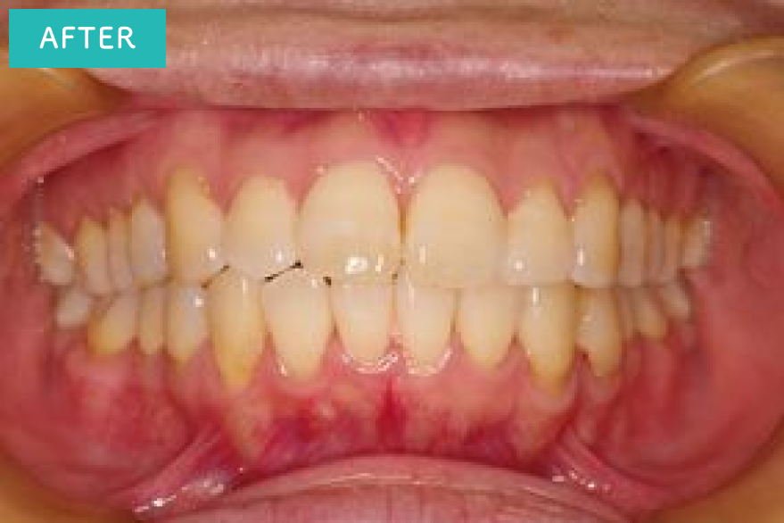 上下ともきれいに並びました。