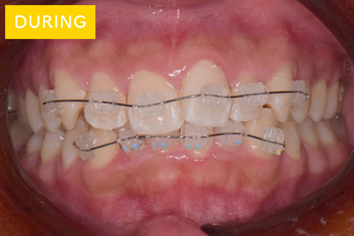 前歯だけ目立たない矯正