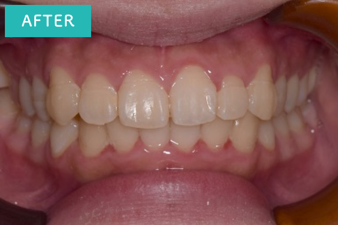 月に2回の通院で5ヶ月で矯正治療終了