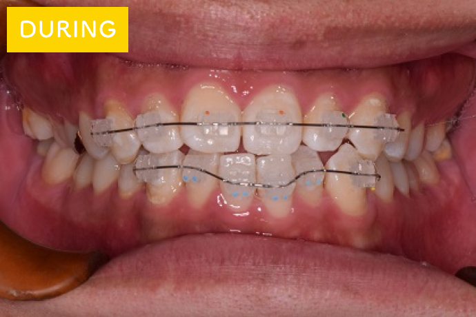 前歯だけ目立たない矯正