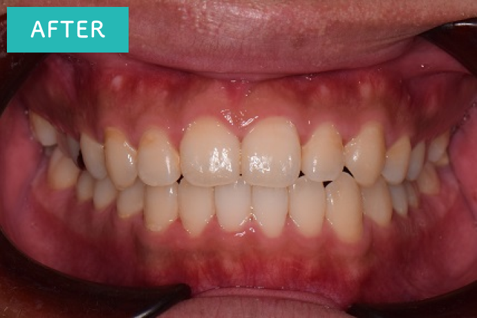 月に2回通院で4か月で矯正治療終了