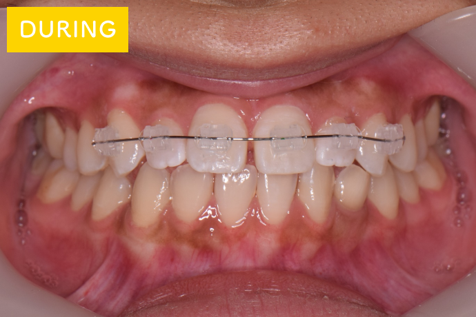 前歯だけ目立たない矯正