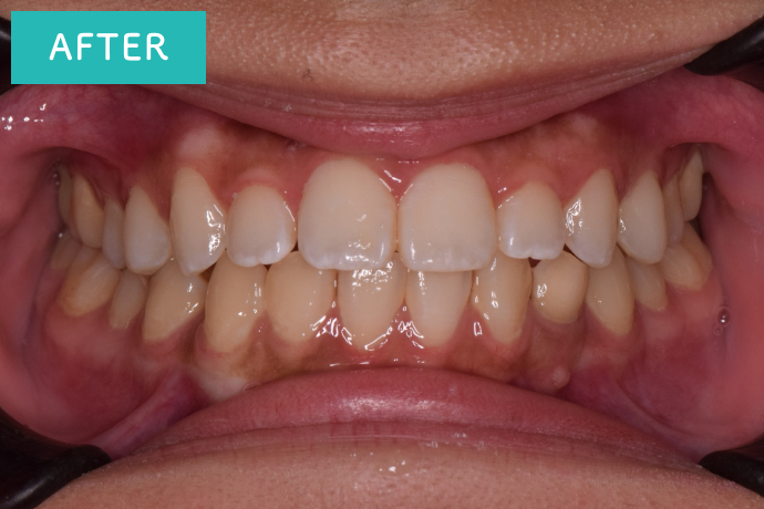 月に2回通院で4か月で矯正治療終了