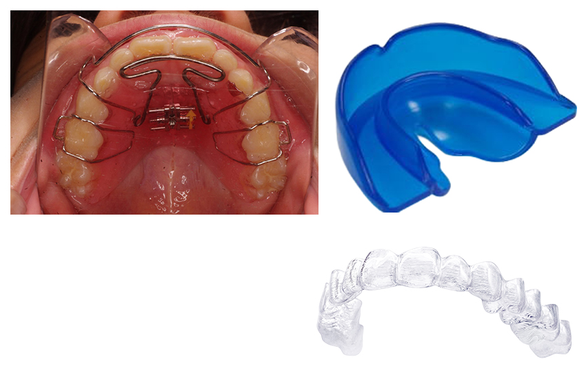 小児矯正の器具