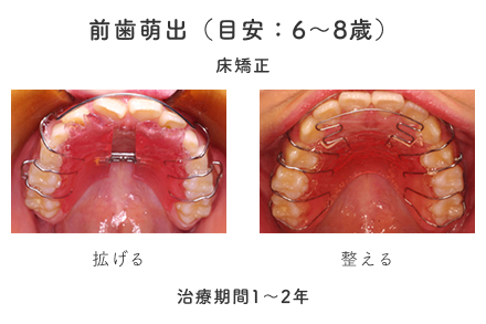 前歯萌出（目安：6〜8歳）