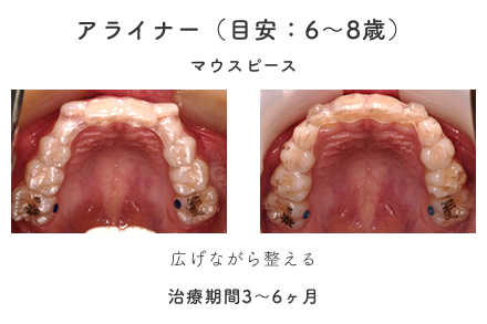 アライナー（目安：6〜8歳）