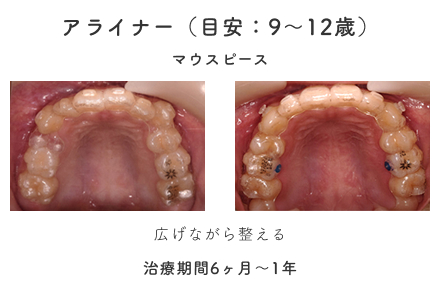 アライナー（目安：9〜12歳）