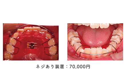 ネジあり装置：70,000円