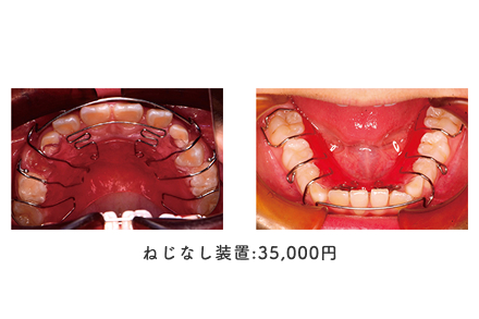 ねじなし装置:35,000円