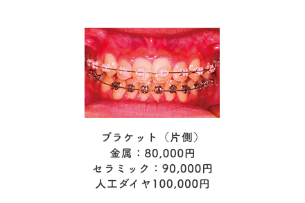 ブラケット（片側）金属：80,000円セラミック：90,000円人工ダイヤ100,000円