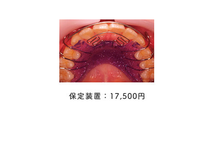 保定装置：17,500円