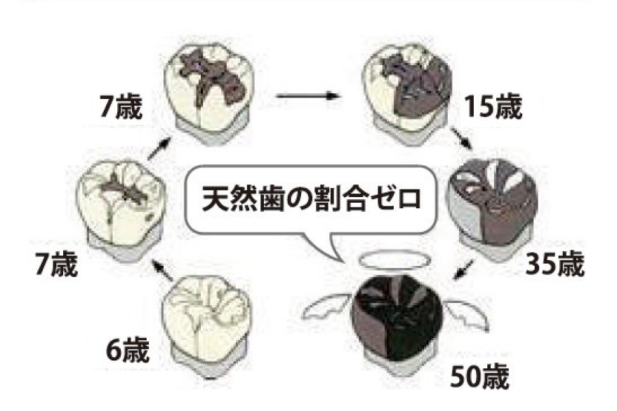 天然歯の割合ゼロ