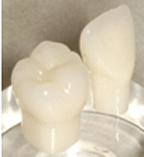 オールセラミック(ファインセラミック)