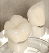 メタルセラミック(メタル+セラミック)