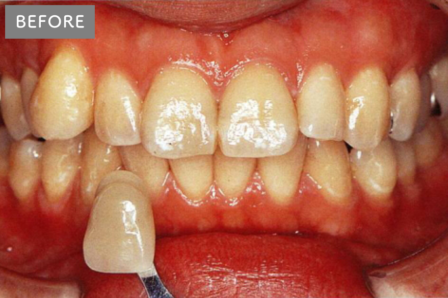上の前歯にガタツキがあります。