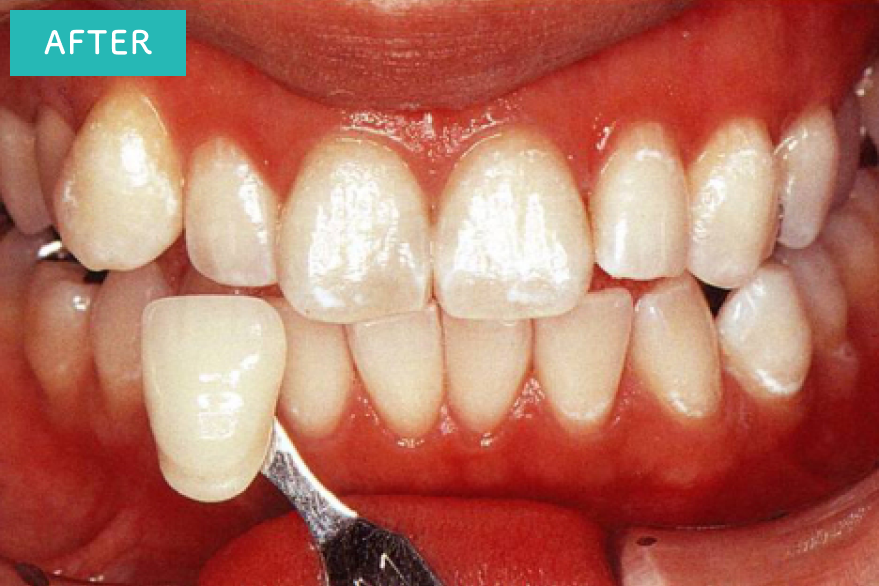 前歯がきれいになりました。
